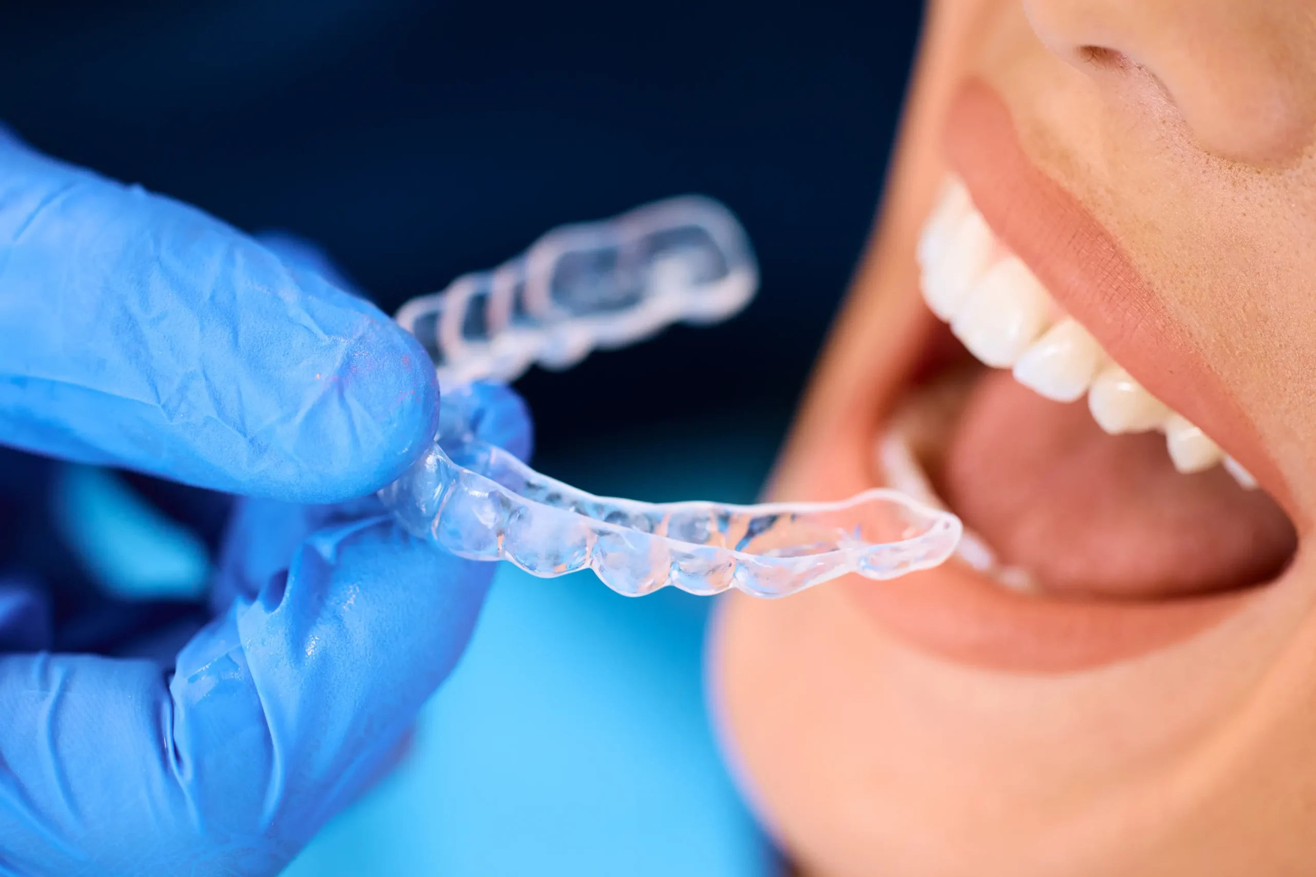 Alineador transparente junto a los dientes
