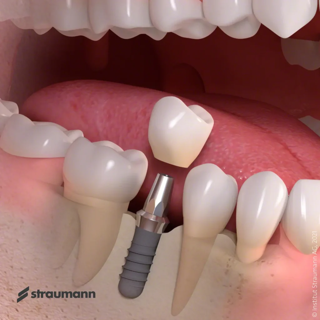 Ilustración de un implante dental Straumann con pilar y corona en el hueso.