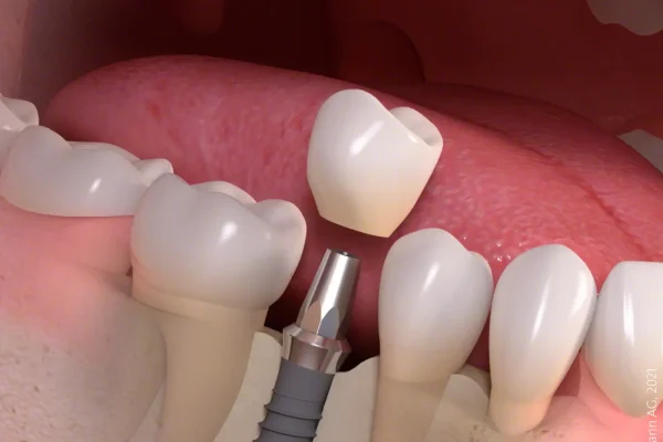 Il·lustració d’un implant dental Straumann amb pilar i corona dins de l’os.