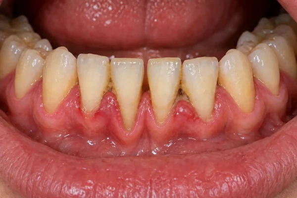 Il·lustració de genives inflamades, recessió gingival i dipòsits de càlcul.