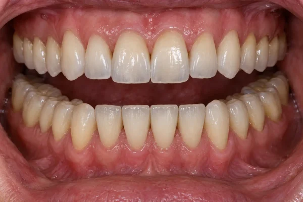Il·lustració de les dues arcades dentals per explicar la rehabilitació oral.